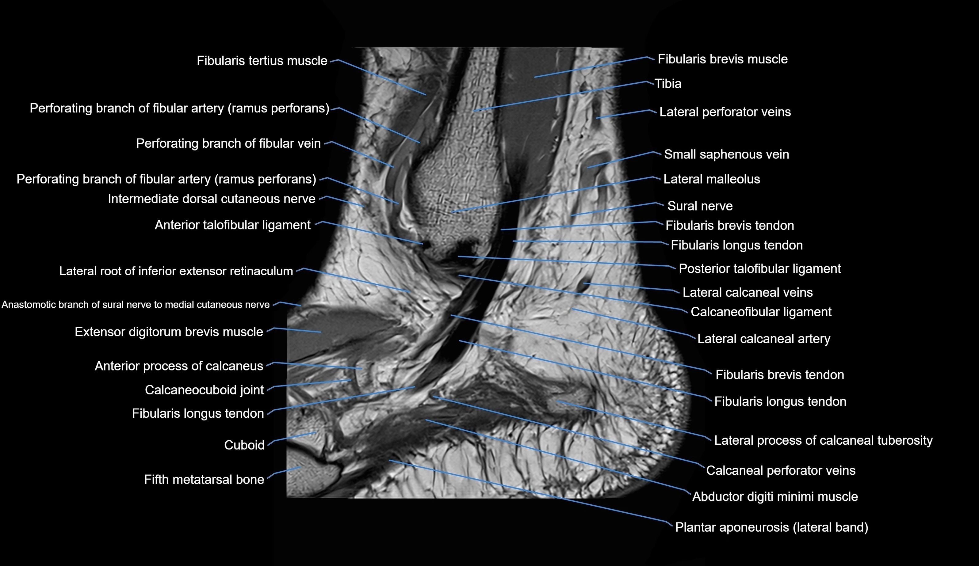 MRI Ankle sagittal cross sectional anatomy 3T  radiology  image-img-00001-00030.webp